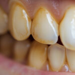 What Happens to the Body After Gallbladder Removal? 3 Diseases That May Follow – Avoid Surgery If Possible