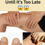 5 Home Remedies to Remove a Splinter